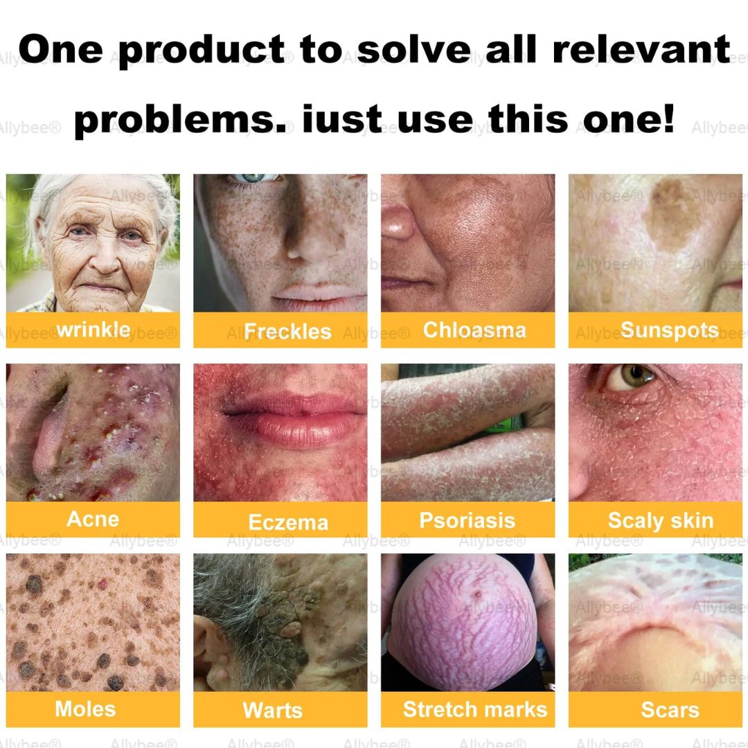 Cream BeeRx™ | Complete Natural Treatment for Psoriasis, Wrinkles and Chronic Skin Diseases!