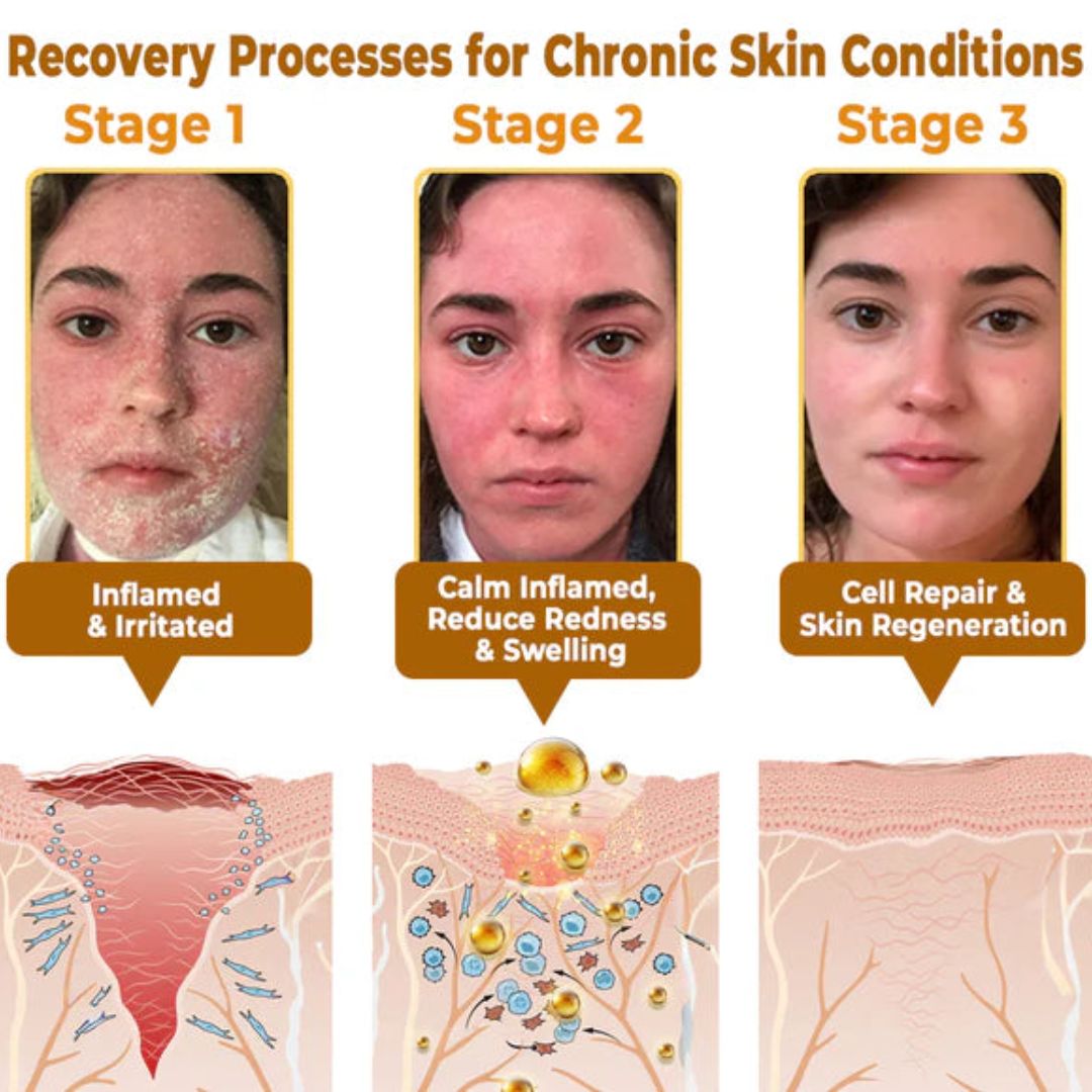 Cream BeeRx™ | Complete Natural Treatment for Psoriasis, Wrinkles and Chronic Skin Diseases!